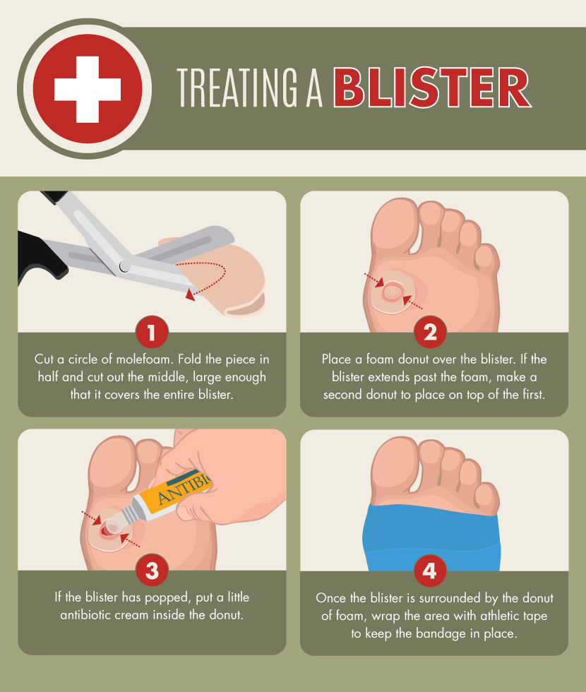 How To Tape a Blister So You Don’t Miss Your Start