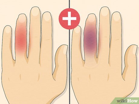 How To Treat a Jammed Finger So You Can Play Tomorrow